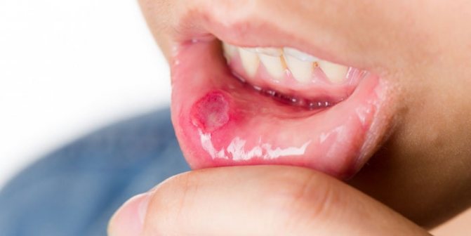 Стоматит у детей: симптомы с фото и лечение, первая помощь, профилактика болезни во рту