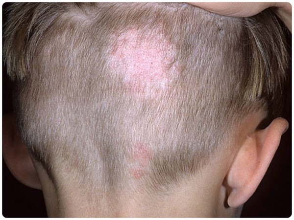 Стригущий лишай у детей на голове: фото, признаки и лечение в домашних условиях