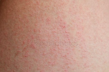 Сыпь у ребенка на попе — фото прыщей с пояснениями, причины аллергии и сухой кожи, лечение