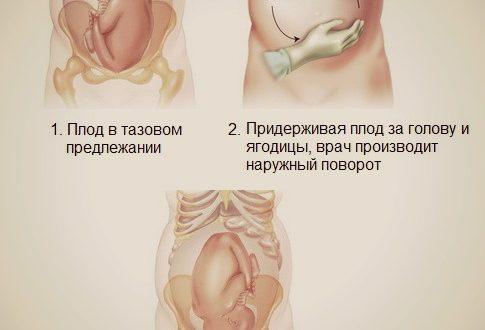 Тазовое предлежание плода: причины, специальные упражнения и способ родов