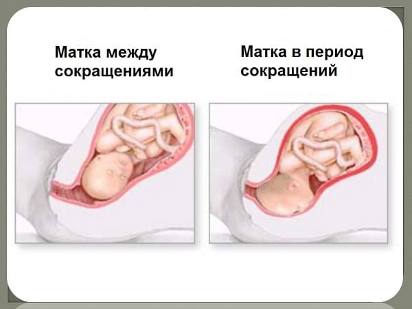 Тонус матки при беременности: симптомы в разных триместрах, способы справиться в домашних условиях