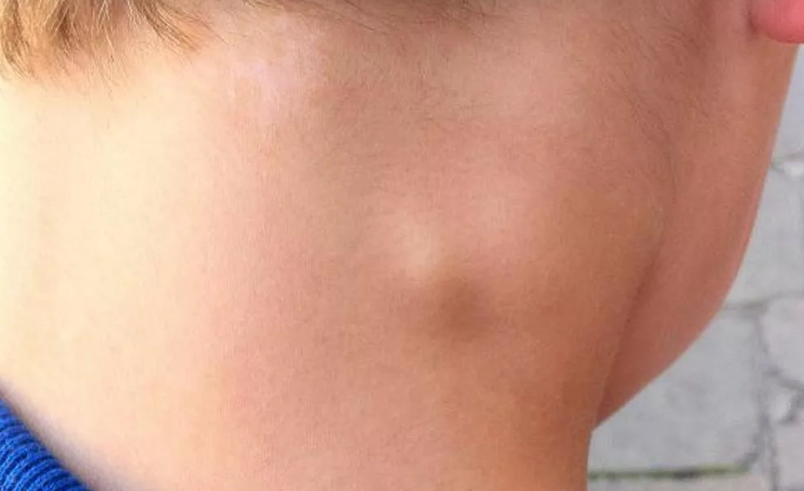 У ребенка на шее шишка под кожей: что это может быть за шарик и как его лечить?