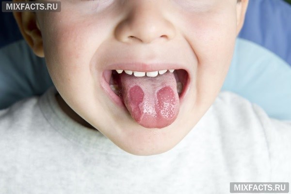 У ребенка на языке пятна: красные, как ожог (фото, диагноз, лечение и причины)