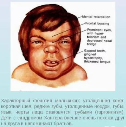 Умственная отсталость у детей: симптомы олигофрении до 3 лет, причины и лечение