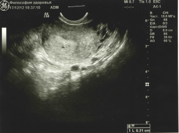 УЗИ 2 недели беременности: фото, что покажет исследование и можно ли увидеть эмбрион