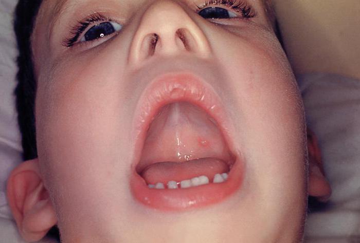 Ветрянка во рту у ребенка: чем обработать горло и язык, как полоскать ротовую полость?