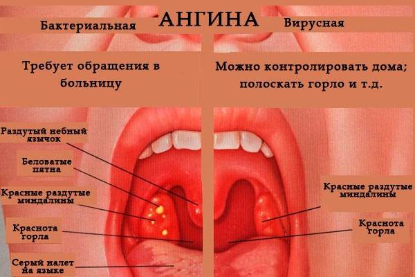 Вирусная ангина у детей: симптомы и лечение, фото горла при тонзиллите