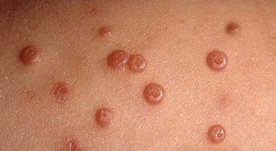 Вирусная пузырчатка у детей: симптомы с фото и методы лечения болезни