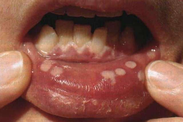 Вирусный стоматит у детей: симптомы и лечение, фото, инкубационный период