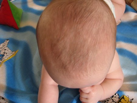 Впалый родничок у грудничка: причины западения темечка с фото