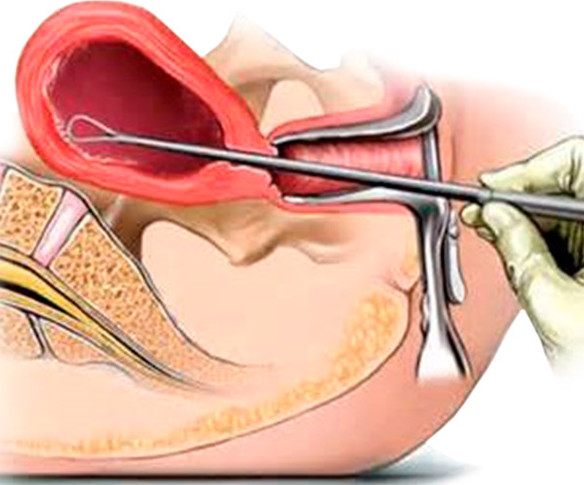 Выскабливание при замершей беременности полости матки: ход процедуры, возможные осложнения