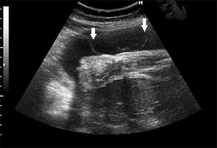 Взвесь в околоплодных водах при беременности: причины, диагностика и лечение