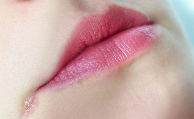 Заеды в уголках рта: причины и лечение у детей, меры профилактики