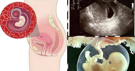 Замершая беременность: причины и признаки замирания плода, лечение и последствия для женщины