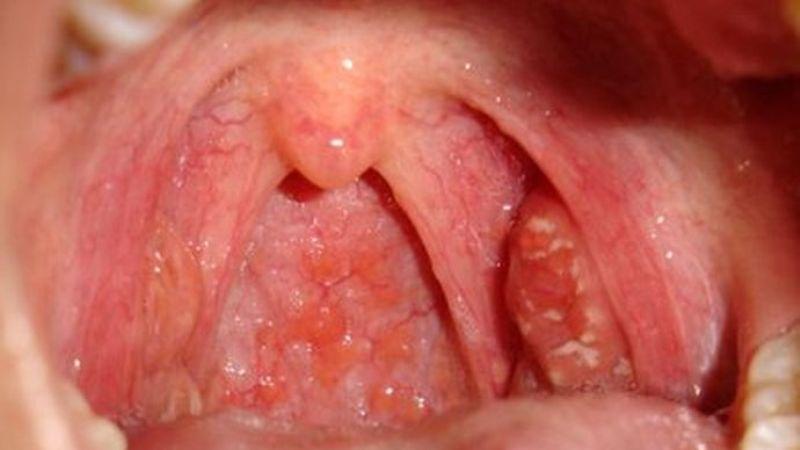 Золотистый стафилококк в горле у ребенка: лечение и симптомы бактерий в мазке из зева