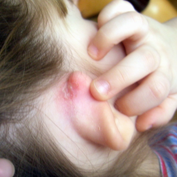 Золотуха у детей за ушами: фото и лечение трещин, мокнущей и шелушащейся кожи