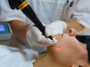 Методы удаления бородавки