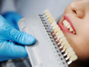 Какие средства необходимы для отбеливания зубов в домашних условиях