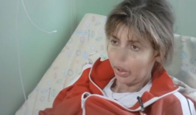 Малахов показал жуткие фото страдающей от некроза носа экс-жены Андрея Аршавина