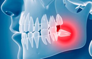Когда необходимо удаление зуба мудрости