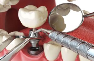 Имплантация зубов: особенности и этапы процедуры