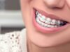 Брекеты: все «за» и «против» их установки