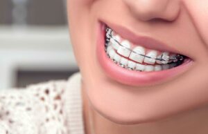 Брекеты: все «за» и «против» их установки