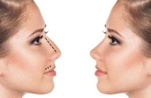 Ринопластика: особенности выбора хирурга и проведения операции