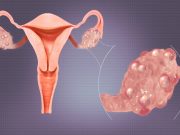 Поликистоз яичников: симптомы, причины, лечение