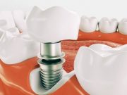 Тенденции и новые технологии в имплантации зубов: цифровая стоматология, навигационные системы и протоколы