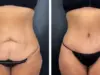 Абдоминопластика — путь к идеальному животу