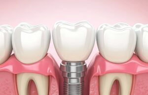 Имплантация зубов — инновационные технологии и их влияние на качество жизни пациентов