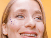 Установка керамических брекетов: эффективный и эстетичный путь к идеальной улыбке