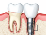 Все включено: преимущества имплантации зубов для вашего здоровья и комфорта